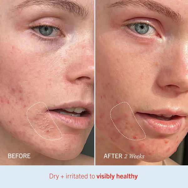 First Aid Beauty Ultra Repair® Cream Intense Hydration – Face and Body Moisturizer for Skin Repair